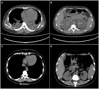 Case report: Page kidney with multiple serosal effusions caused by bilateral spontaneous renal subcapsular hemorrhage